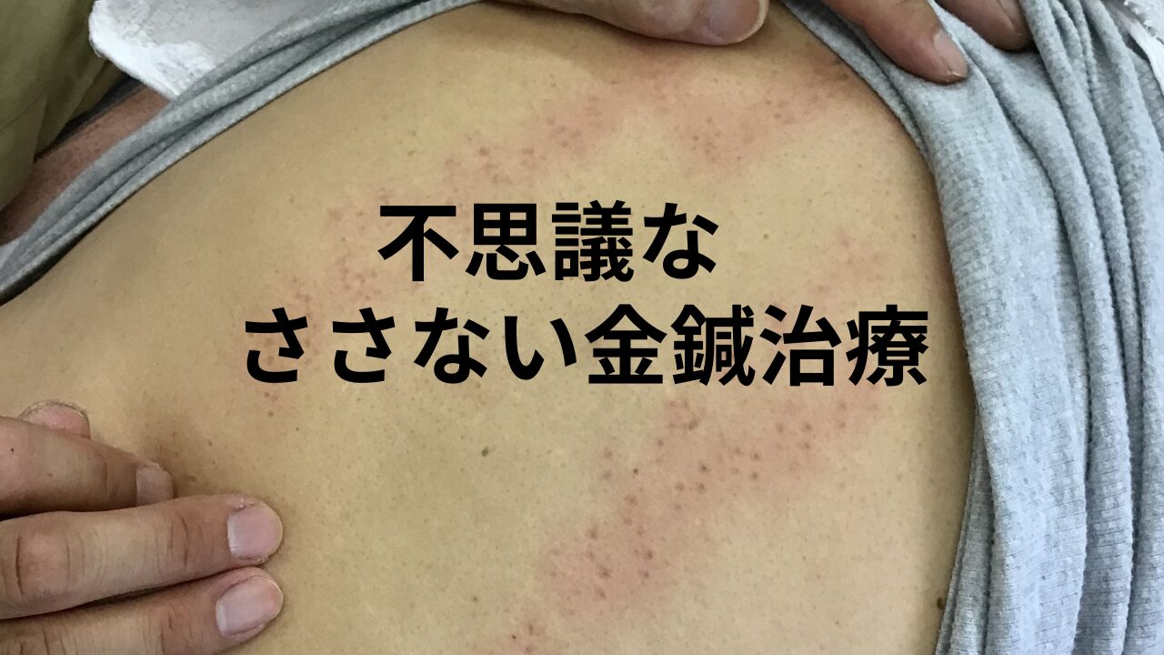 刺さない鍼治療